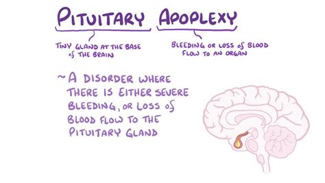 Pituitary apoplexy - Osmosis