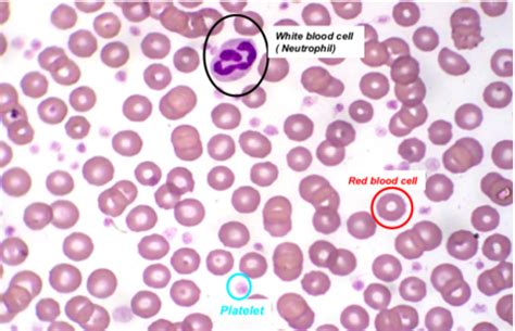 Week 5 Erythrocyte Disorders Flashcards Quizlet