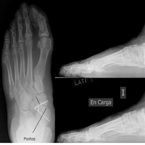 Radiological Lateral View Of An Early Stage Iii Adult Acquired