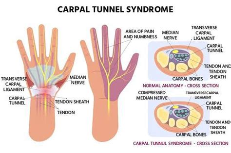 Causes Of Carpal Tunnel Syndrome Medizzy