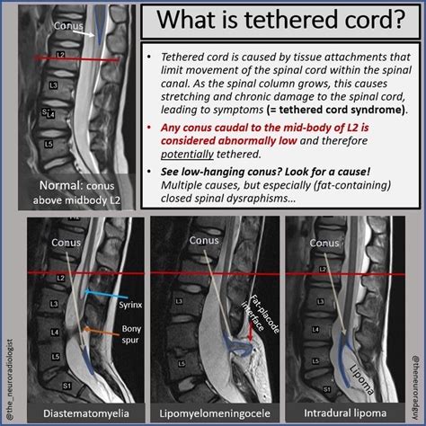 Oren Gottfried Md On Twitter Treating This Tethered Cord By Cutting