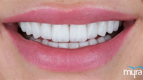 5 Side Effects Of Dental Veneer