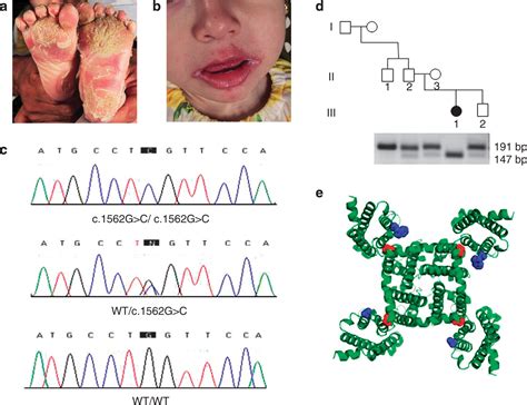 Olmsted Syndrome Caused By A Homozygous Recessive Mutation In Trpv3