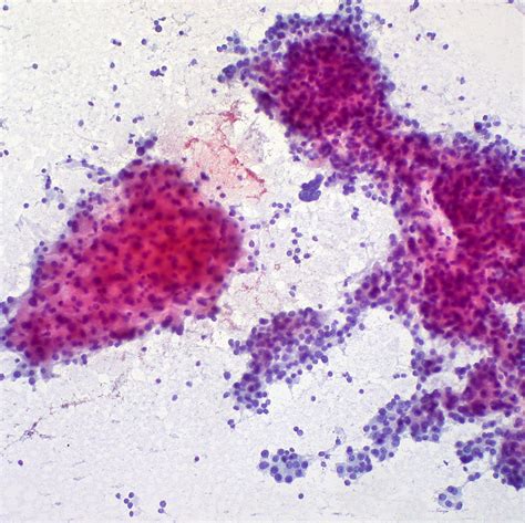 Hepatocellular Carcinoma Liver Fna Ed Uthman Flickr