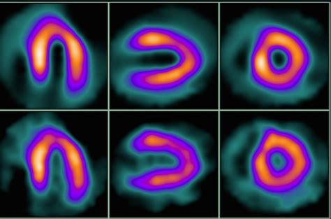 Myocardial Perfusion Imaging Mechanism Medicine Specifics