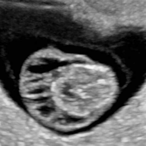 First Trimester Septated Cystic Hygroma In A 29 Year Old P2 At 11 And