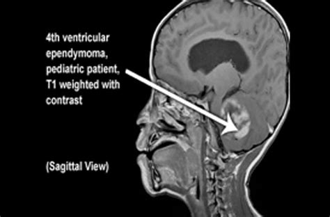 Ependymoma