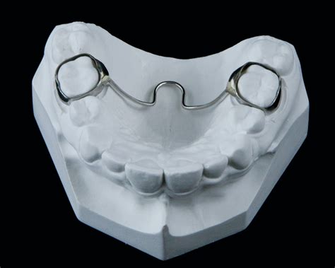 Transpalatal Arch Tpa