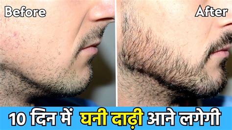 घनी दाढ़ी और मूंछ उगाने का असरदार उपाय How Fix Patchy Beard