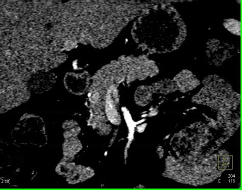 Subtle Incidental Neuroendocrine Tumor In The Head Of The Pancreas