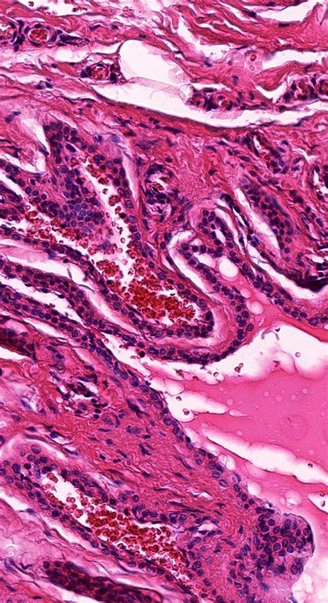 Pin On Dermatopathology Quiz Cases