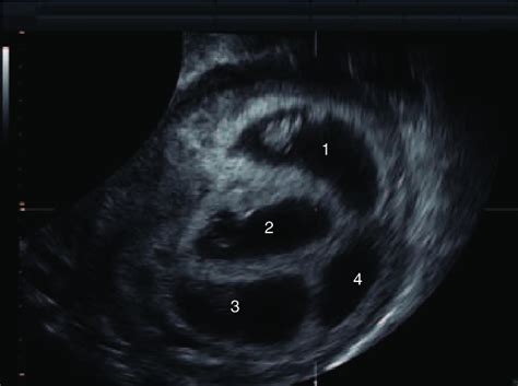 Quadrochorionic Quadruplets This First Trimester Scan Demonstrates The