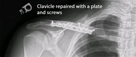 Clavicle Fractures Dr Michael Codsi Patient Education Michael