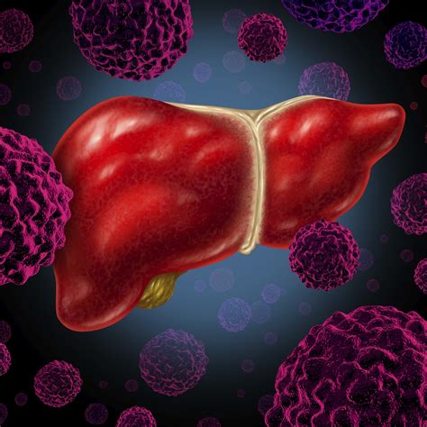 Liver Cancer And Hepatitis B Hep