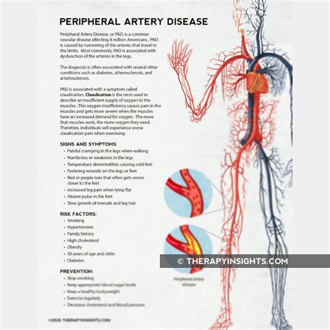 Peripheral Artery Disease Therapy Insights