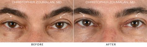 Ptosis Surgery Before And After Photo Gallery