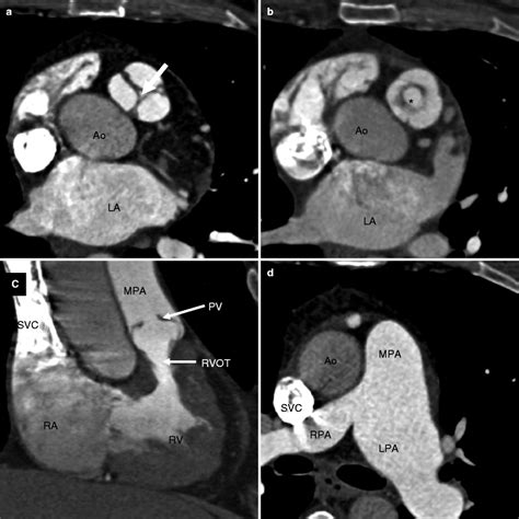 Left Ventricular Outflow Tract Anatomy