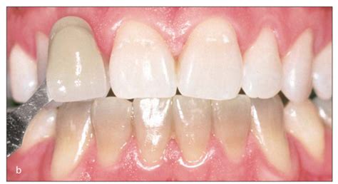 4. Tetracycline-Stained Teeth | Pocket Dentistry