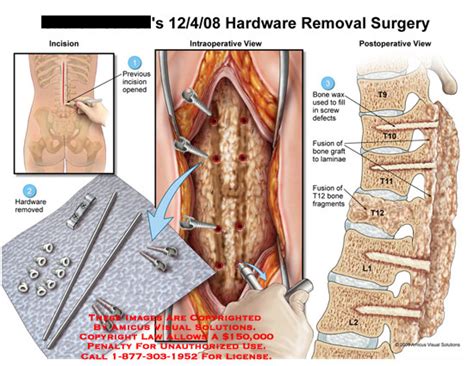 AMICUS Illustration Of Amicus Surgery Hardware Removal Removed Bone Wax