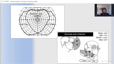 Pole Widzenia Interpretacja Przyk Ady Medelight Kursy Medyczne