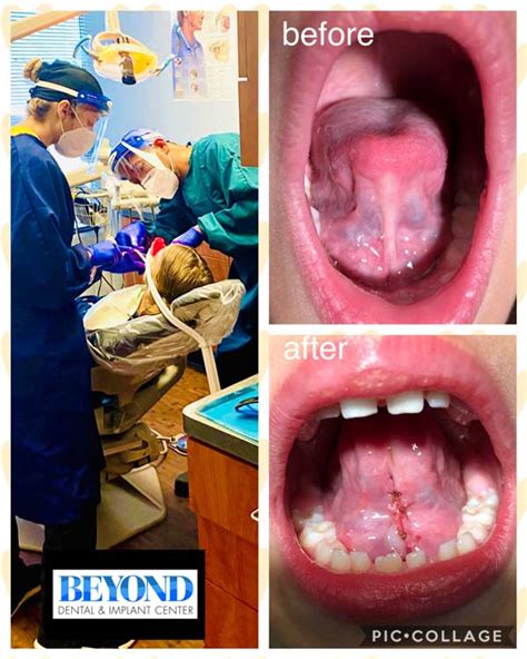 Tongue Tie Surgery Before & After Gallery in Dallas, TX