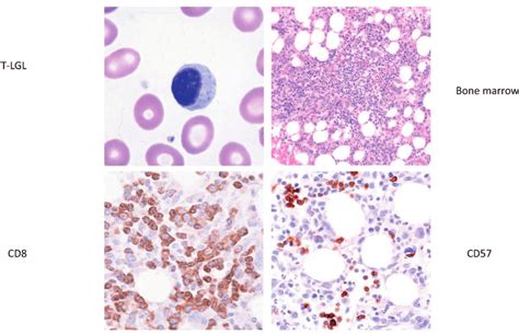 What is Large Granular Lymphocytic Leukemia (LGLL)?