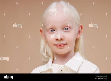 Close Up Portrait Of Little Caucasian Girl With Albinism Syndrome Abnormal Deviations Unusual