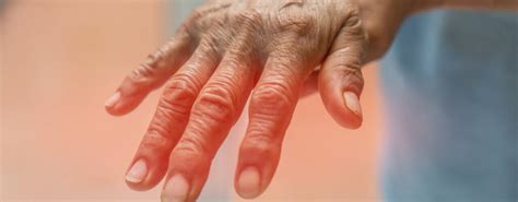 Arthritis Can Be Exhausting Physiotherapy Can Help