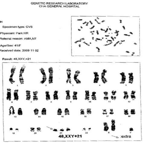 Karyotype Showing 3 Copies Of Chromosome 21 2 Copies Of Chromosome X