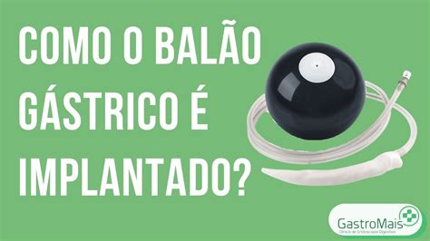 Bal O G Strico Medicone Corporea Como O Procedimento De Coloca O E