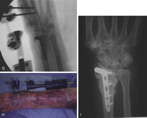 Essential Radiographic Evaluation For Distal Radius Fractures