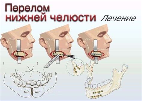 Перелом Верхней Челюсти Фото Telegraph