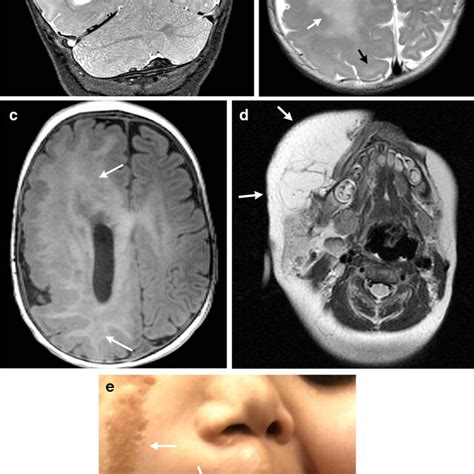 Megalencephaly Capillary Malformation Mcap Syndrome In A