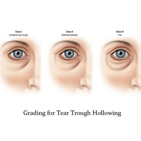 Tear Trough Treatment Solutions To Improve Dark Circles And Hollowness