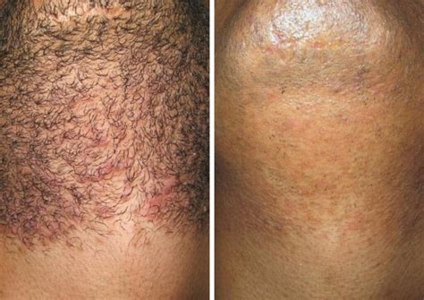 Full Brazilian Laser Hair Removal Before And After Photos