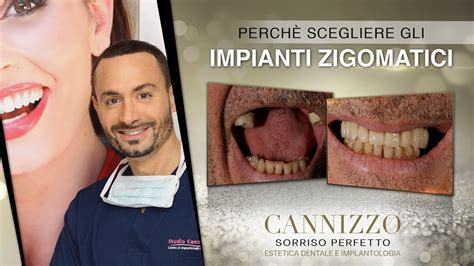 Caso Studio Di Implantologia Zigomatica Studio Cannizzo Youtube