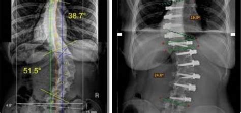 Cirugía De La Escoliosis Sin Fijar La Columna