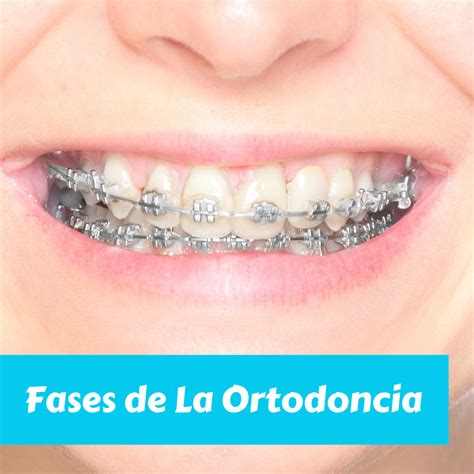 Cuales Son Las Fases De La Ortodoncia Odontolog A Caballito