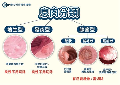 9成大腸癌「從息肉病變」！3形狀最易成癌 愛吃紅肉、燒烤超危險 Ettoday健康雲 Ettoday新聞雲