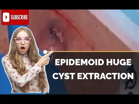 Cysts Extraction This Week A Huge Epidermoid Infectious Cyst Removal