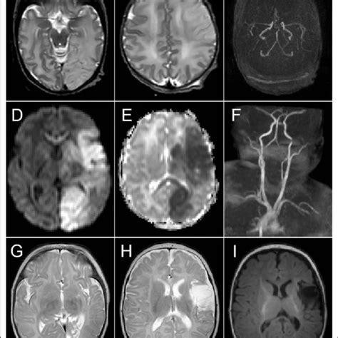 At The Age Of 3 Days A B T2 Weighted Axial Tse Sequence Image Of The