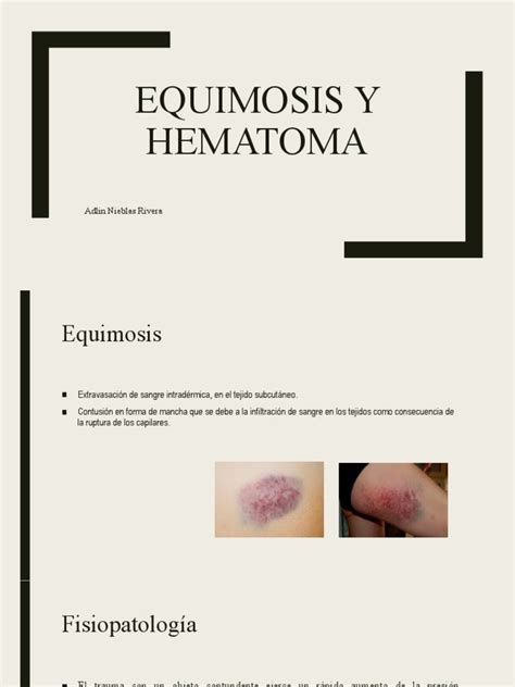 Equimosis Y Hematoma Pdf