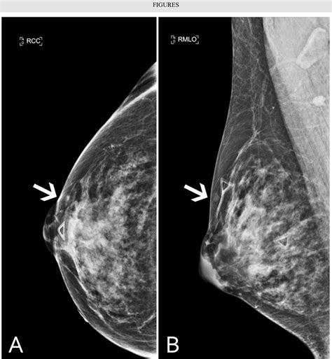 Pdf Granulomatous Mastitis In A Transgender Patient Semantic Scholar