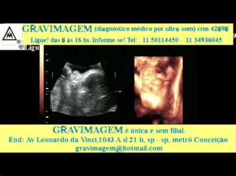 Gravimagem Ultrassom Morfol Gico De Gravidez D D Youtube