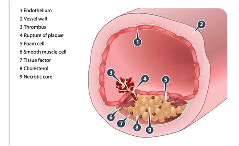 Arterial Thrombosis An Atherosclerotic Plaque Develops Through The