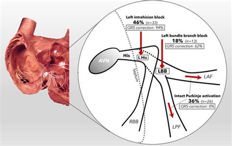 Intracardiac Delineation Of Septal Conduction In Left Bundle Branch Block Patterns Circulation