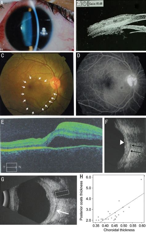 The Clinical Features Of Posterior Scleritis With Serous Retinal