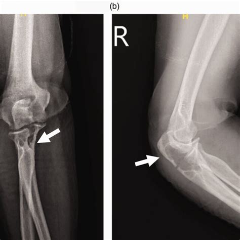 A Anteroposterior Radiography View Of The Right Elbow B Lateral