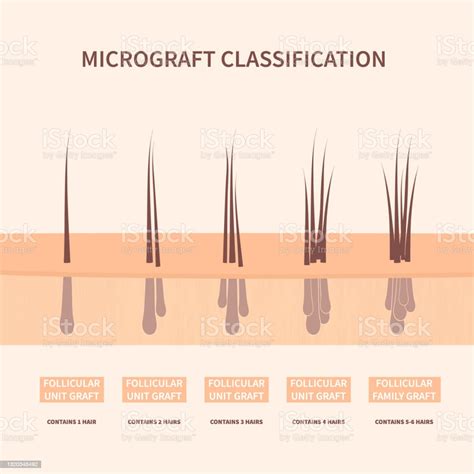 모발 이식용 모발 이식 타입 Hair Transplant에 대한 스톡 벡터 아트 및 기타 이미지 Hair Transplant