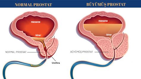 Prostat Ürolife